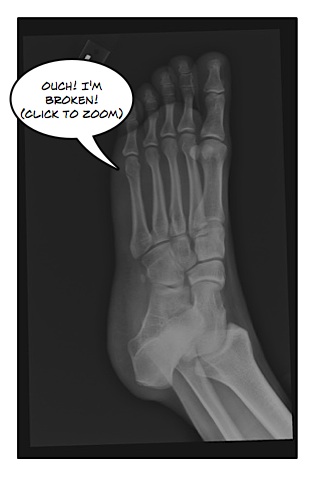 Foot Fracture